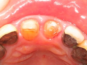 甲2　ラミネートべニア　トオールセラミッククラウン　削り（上面）